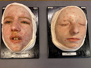 Links im Bild: Wachsmoulage des Gesichtes von Frieda W., welche während der letzten Epidemie in Zürich 1921 mit Pocken (Variola) angesteckt worden war. Hergestellt von Lotte Volger, Dermatologische Klinik, Kantonsspital Zürich