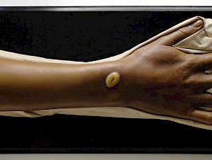 Moulage Pestpustel aus der Medizinhistorischen Sammlung der Universität Bern